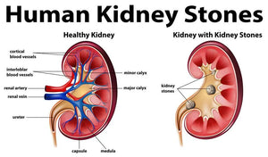 Avoid Kidney Stones - Stay Hydrated!