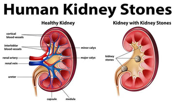 Avoid Kidney Stones - Stay Hydrated!